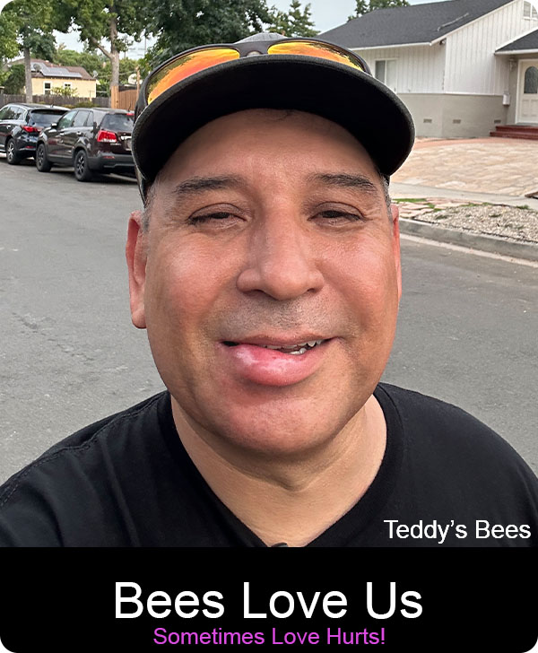 picture of a teddys bees service technician with a swollen lip from a bee sting. Ouch!